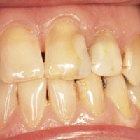 anterior restoration