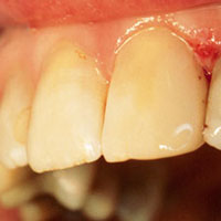 anterior restoration