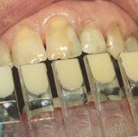 anterior restoration
