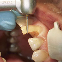 anterior restoration