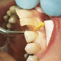 anterior restoration