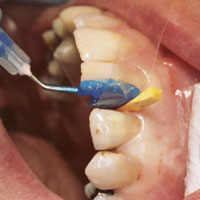 anterior restoration