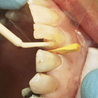 anterior restoration