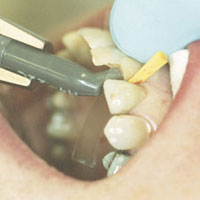 anterior restoration