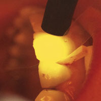 anterior restoration