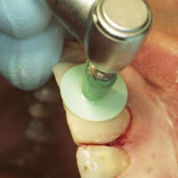 anterior restoration