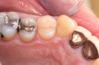 amalgam replacement