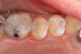 amalgam replacement