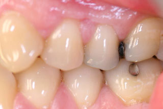 amalgam replacement