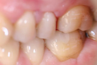 amalgam replacement