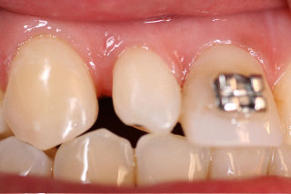Diastema distal
