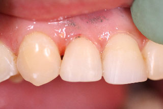 Diastema distal