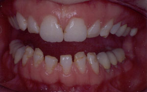 Amelogenesis Imperfecta