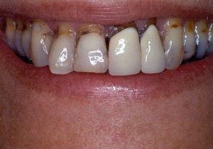 Crown restoration