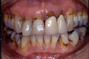 Crown restoration