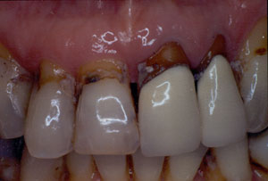 Crown restoration