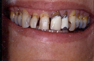 Crown restoration