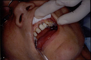 Crown restoration