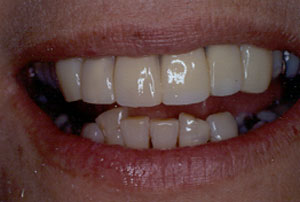 Crown restoration