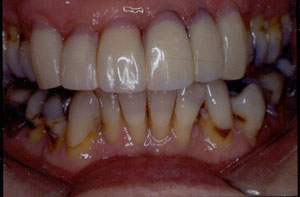 Crown restoration