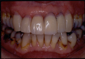 Crown restoration