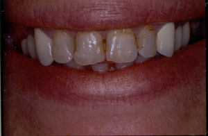 Poor restorations