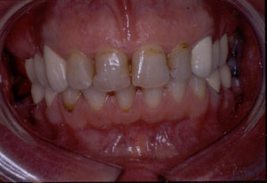 Poor restorations