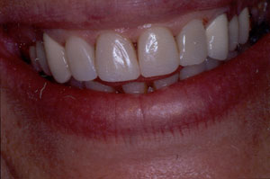 Poor restorations