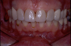 Poor restorations