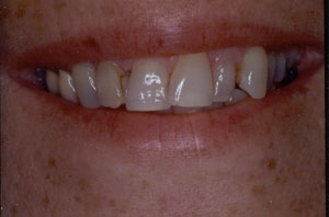 Poor restorations 2