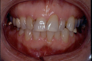 Poor restorations 2