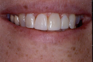 Poor restorations 2