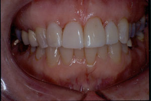 Poor restorations 2