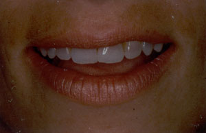 Tetracycline discoloration