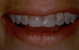 Tetracycline discoloration
