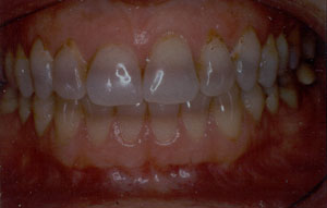 Tetracycline discoloration