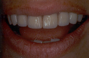 Tetracycline discoloration