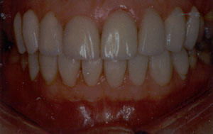 Tetracycline discoloration