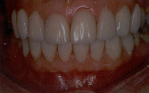 Tetracycline discoloration