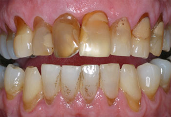 Veneers