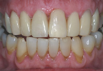 Veneers