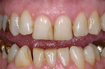 Poor restorations
