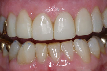 Poor restorations