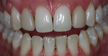 Cosmetic restoration blacklight