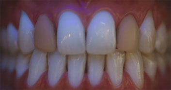 Cosmetic restoration blacklight