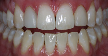 Cosmetic restoration blacklight