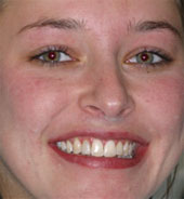 Cosmetic restoration blacklight
