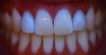 Cosmetic restoration blacklight