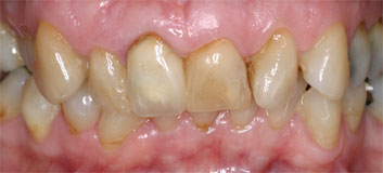 Old restaurations discoloration and crowding