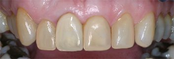 Old restaurations discoloration and crowding